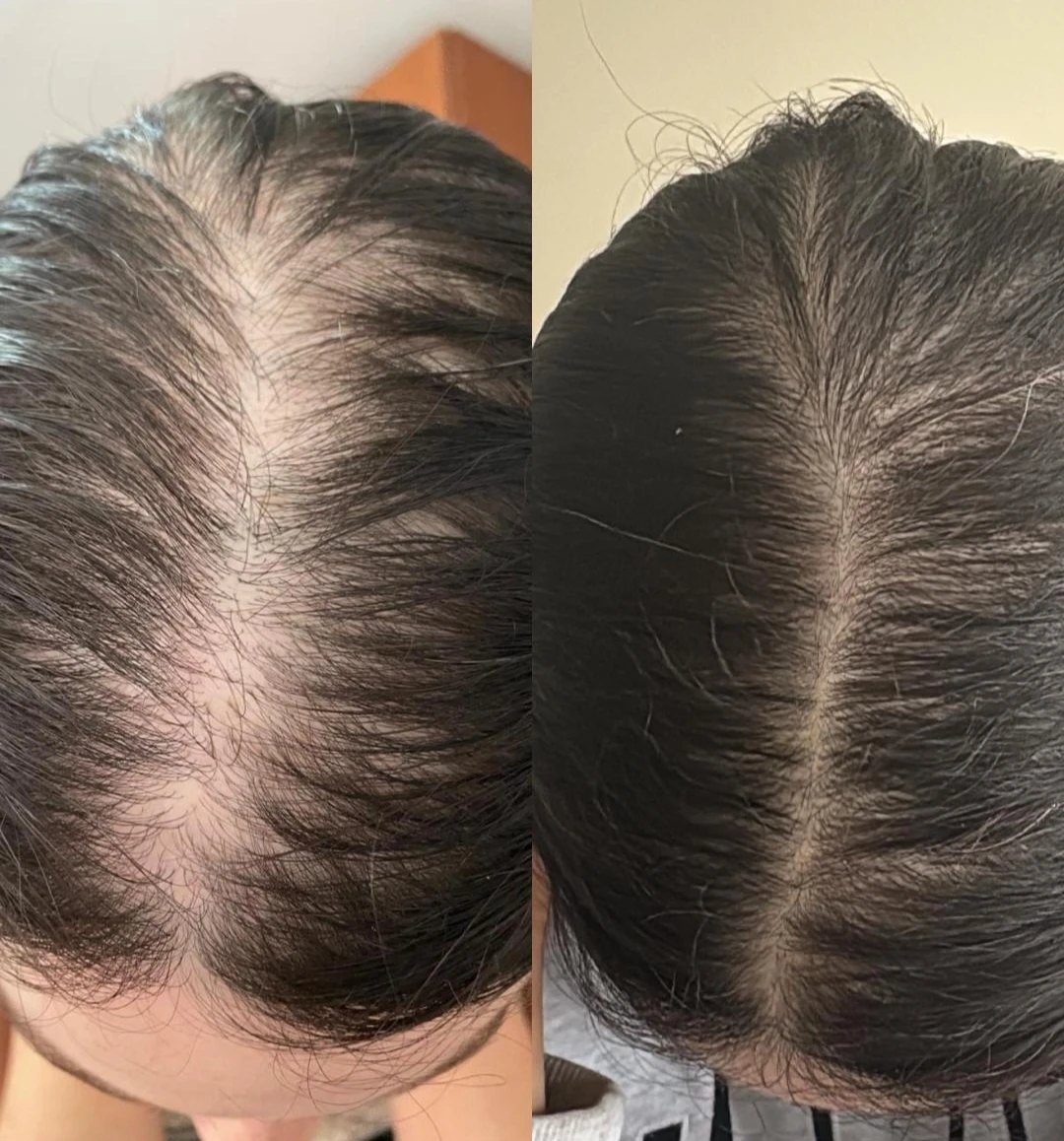 Resultado de tratamento capilar — antes e depois, densidade da repartição