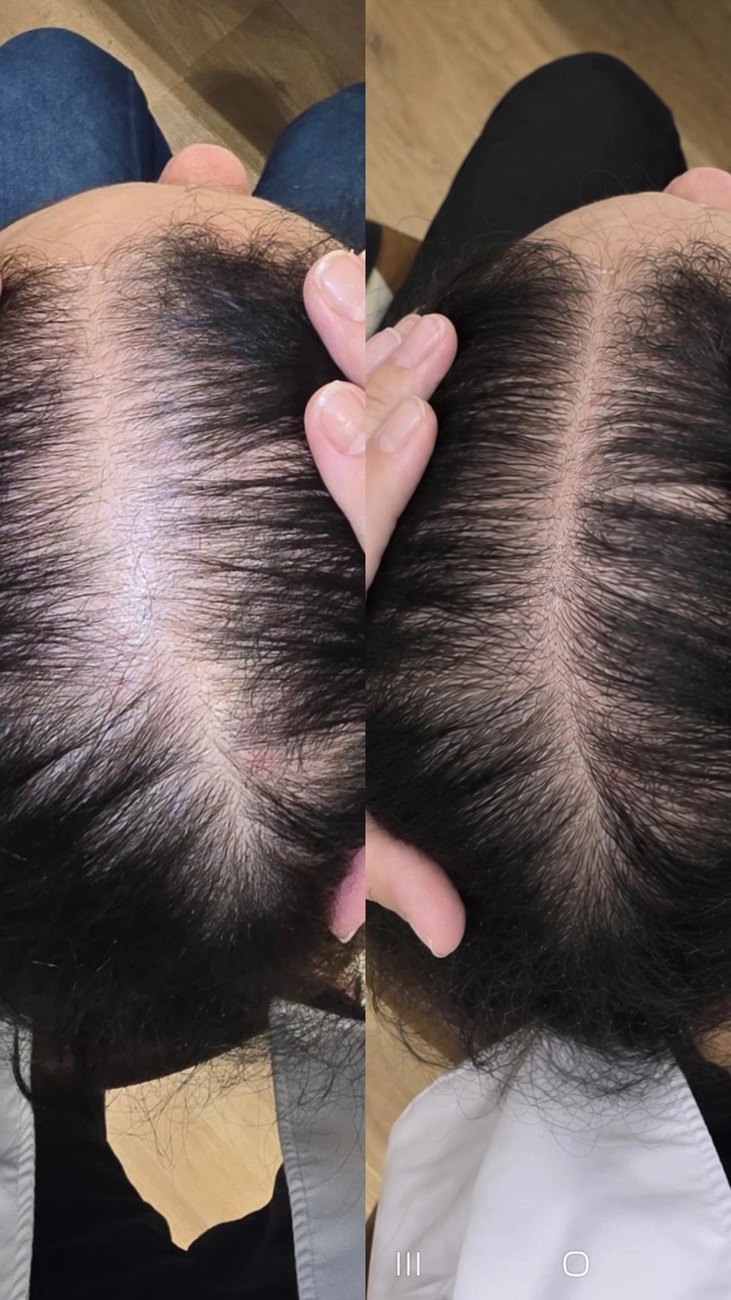 Resultado de transplante capilar — antes e depois, densidade do topo