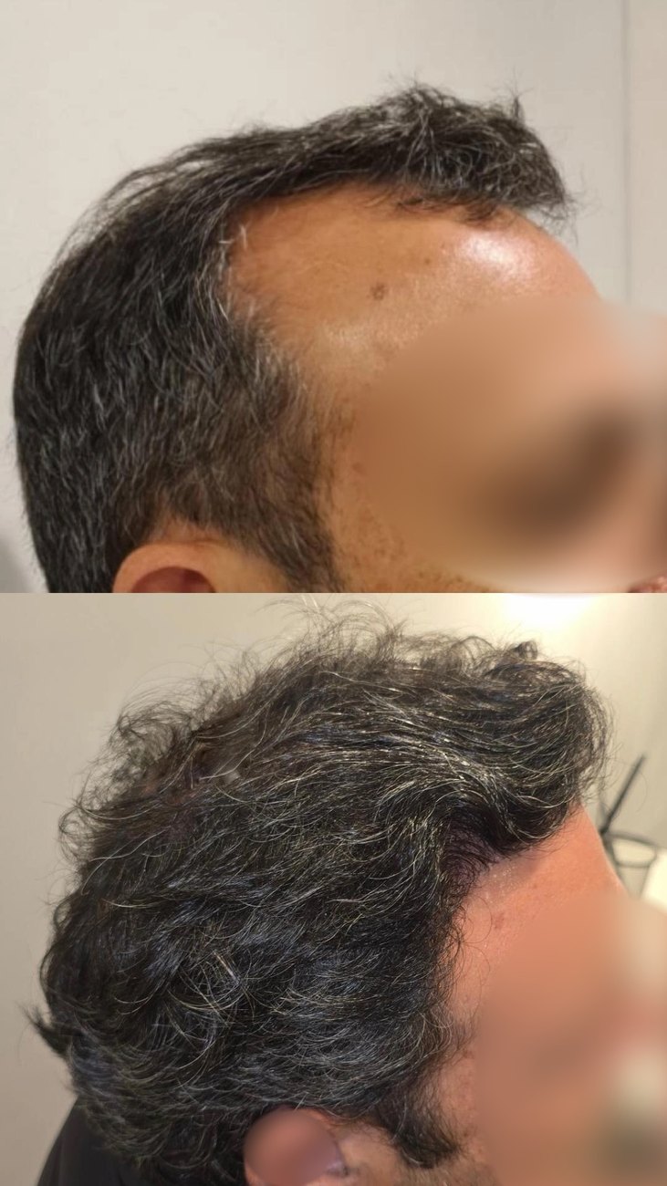 Resultado de transplante capilar — antes e depois, perfil