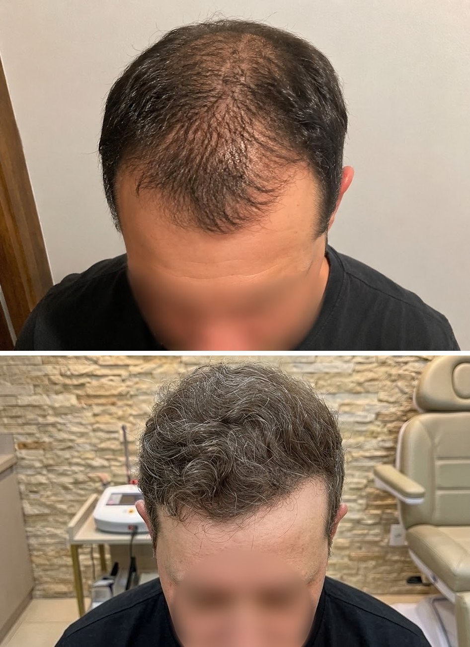 Resultado de transplante capilar — antes e depois, vista frontal