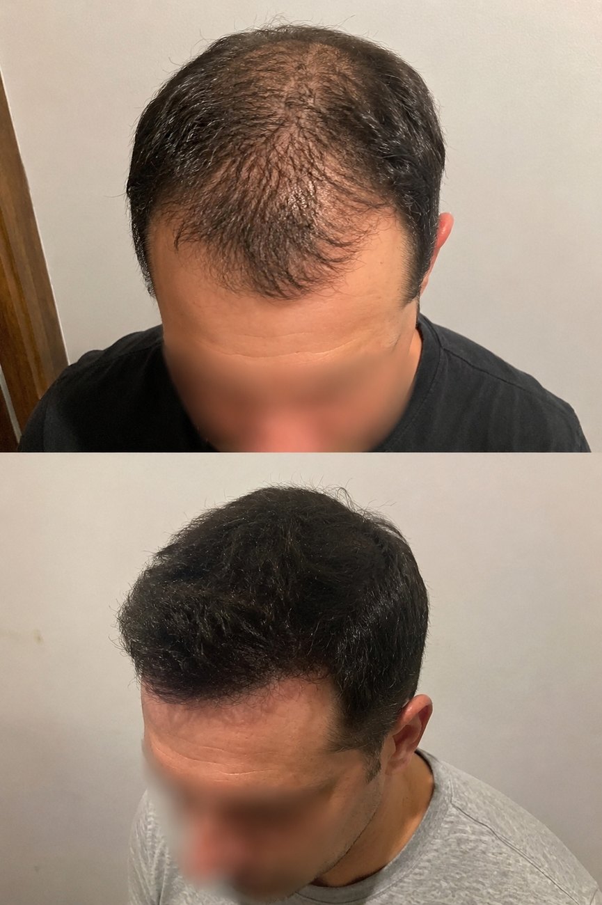 Resultado de transplante capilar — antes e depois, vista frontal