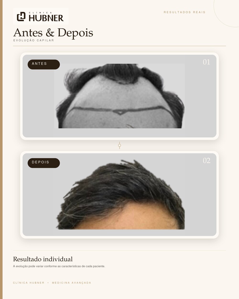 Resultado de transplante capilar — antes e depois, vista frontal