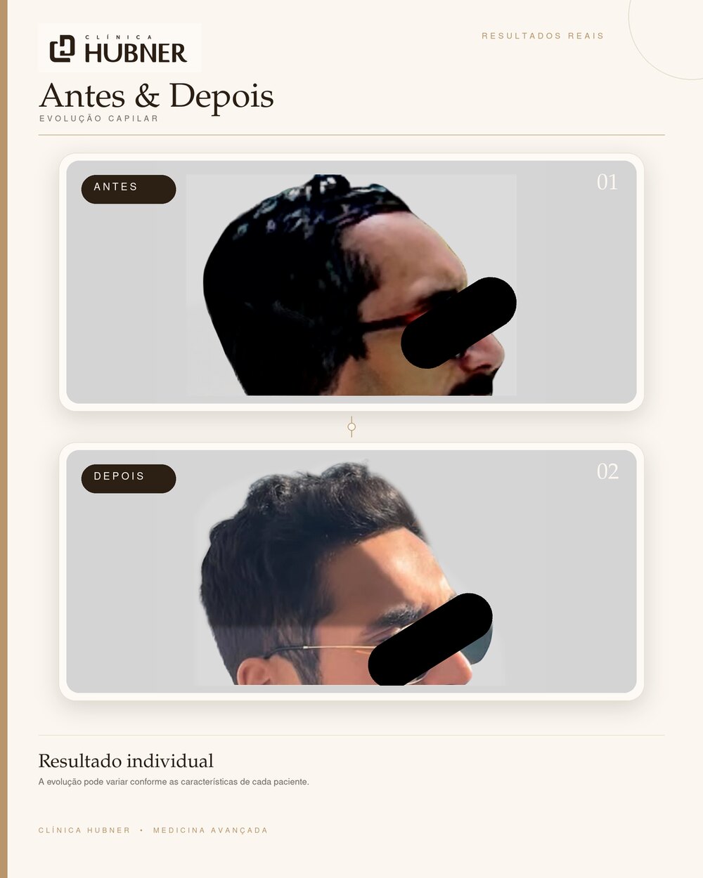 Resultado de transplante capilar — antes e depois, perfil