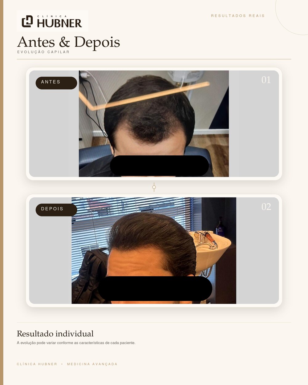 Resultado de transplante capilar — antes e depois, perfil
