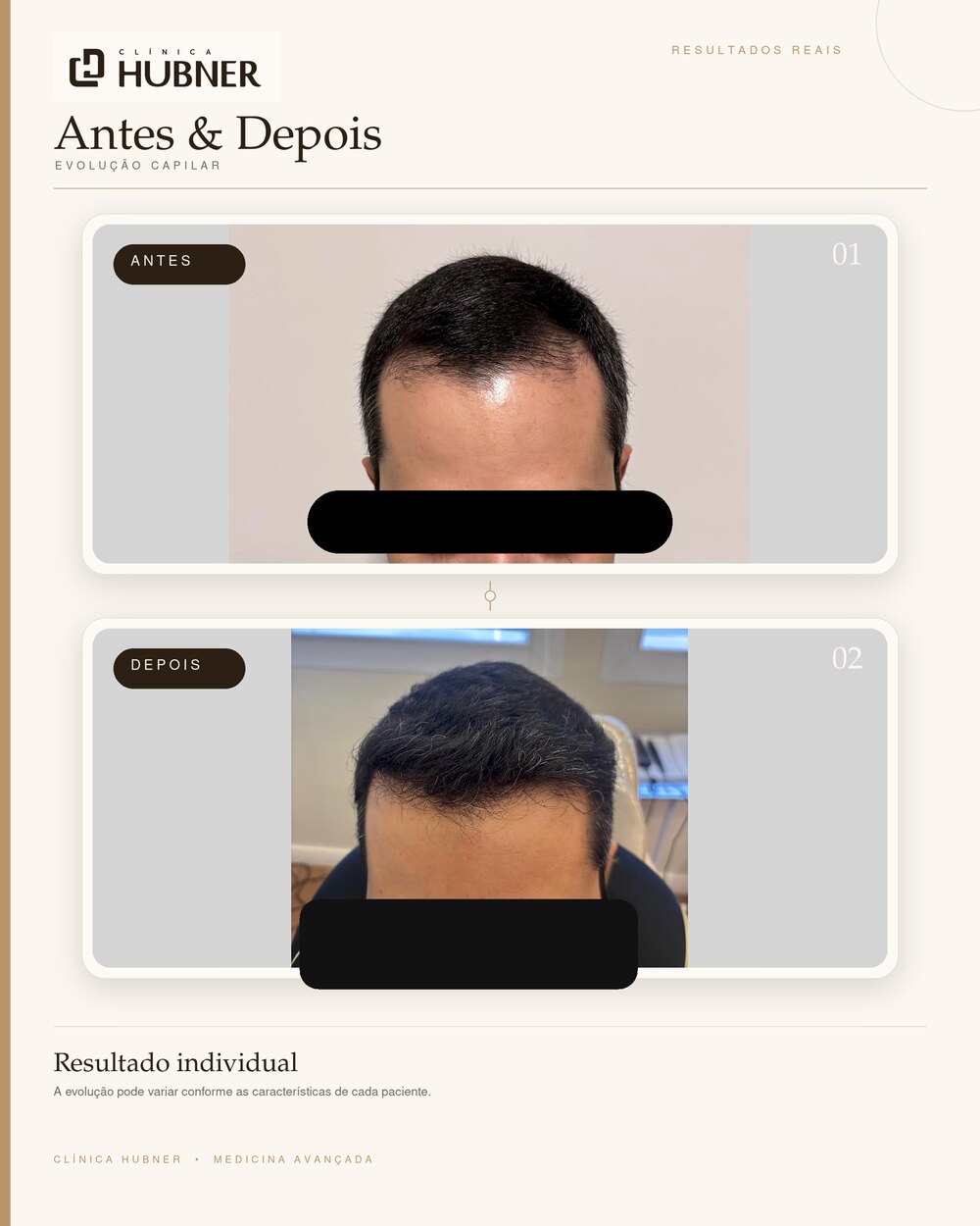 Resultado de transplante capilar — antes e depois, vista frontal